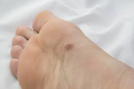 Is Heel Pain: A Sign of Cancer